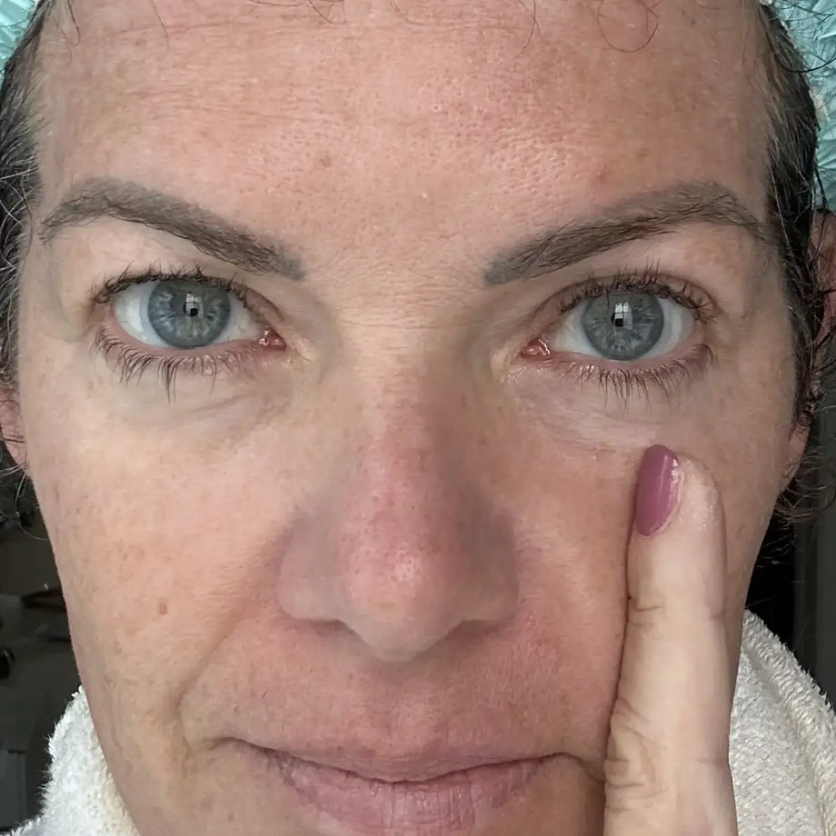 Katy before and after using GLARISE eyelid strips