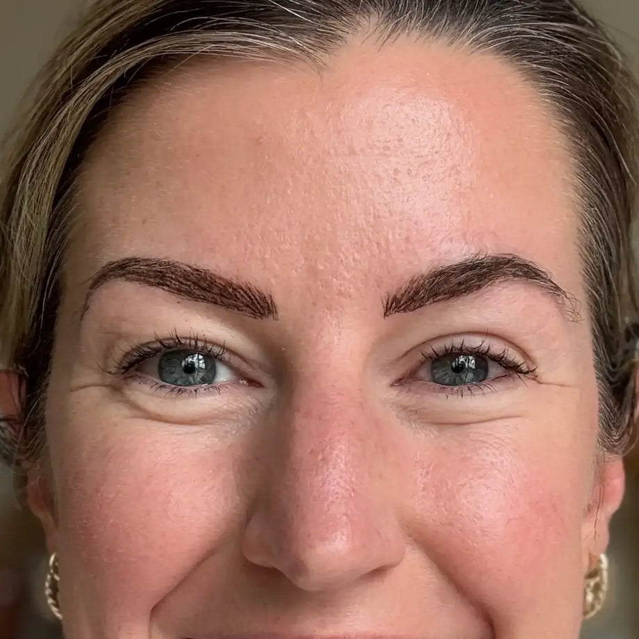 Kelly before and after using GLARISE eyelid strips