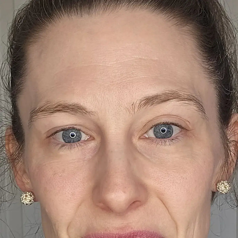 Sarah before and after using GLARISE eyelid strips