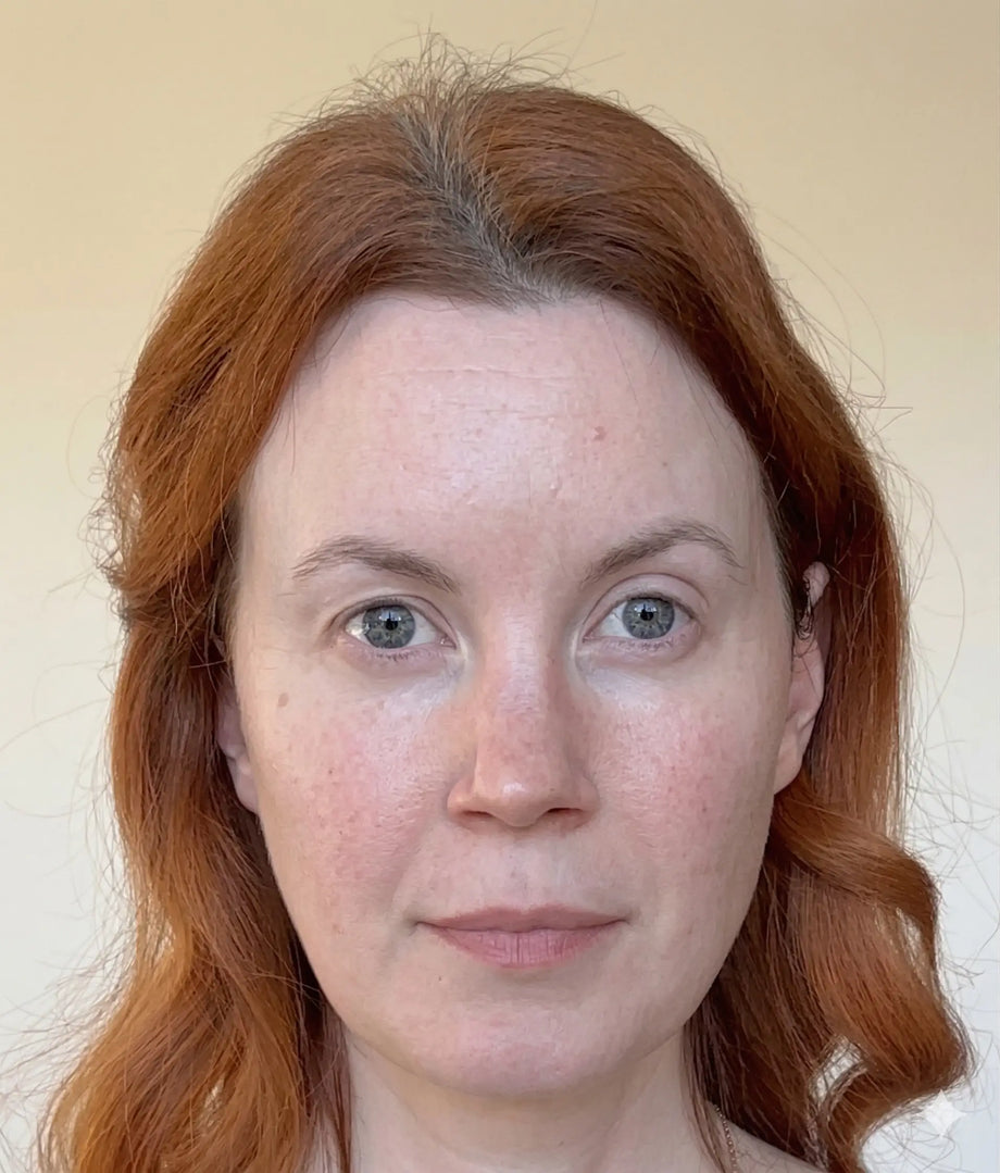Bobbie before and after using GLARISE eyelid strips