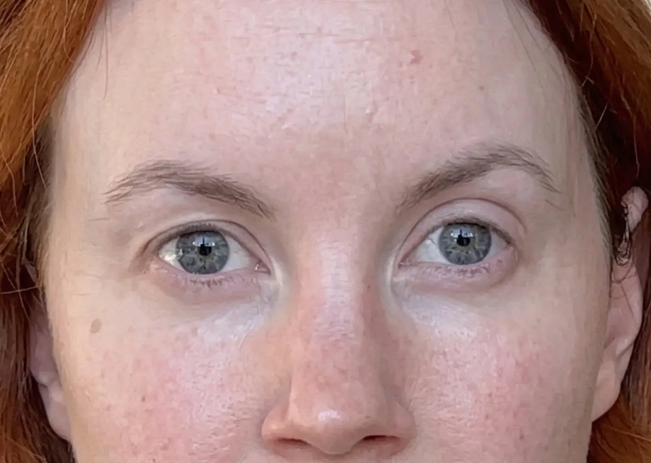 Bobbie before and after using GLARISE eyelid strips