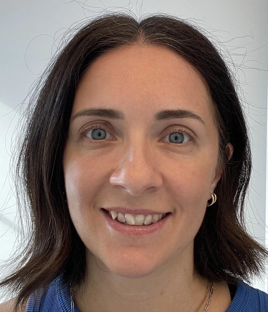 Cara result photo before-and-after eye-area result using GLARISE eyelid strips