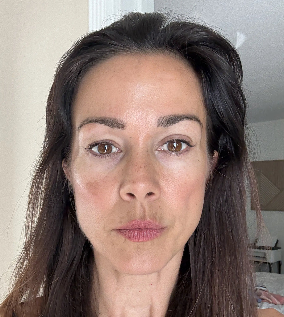 Colleen result photo before-and-after eye-area result using GLARISE eyelid strips