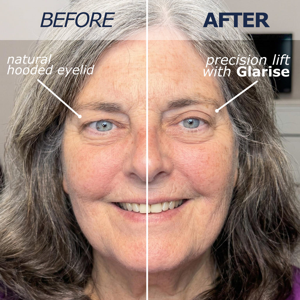 Front view of the GLARISE Corrective Eyelid Strips package and applicator