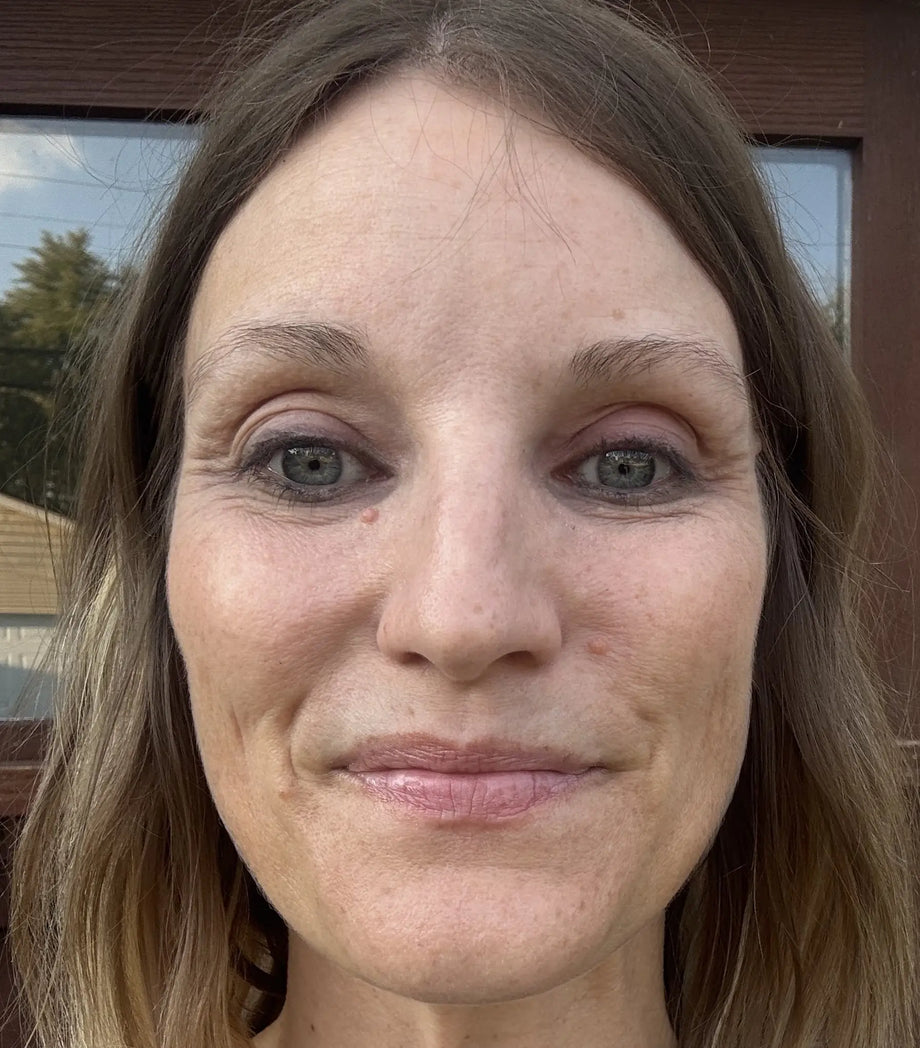 Kate result photo before-and-after eye-area result using GLARISE eyelid strips