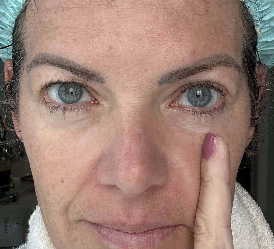Katy result photo before-and-after eye-area result using GLARISE eyelid strips