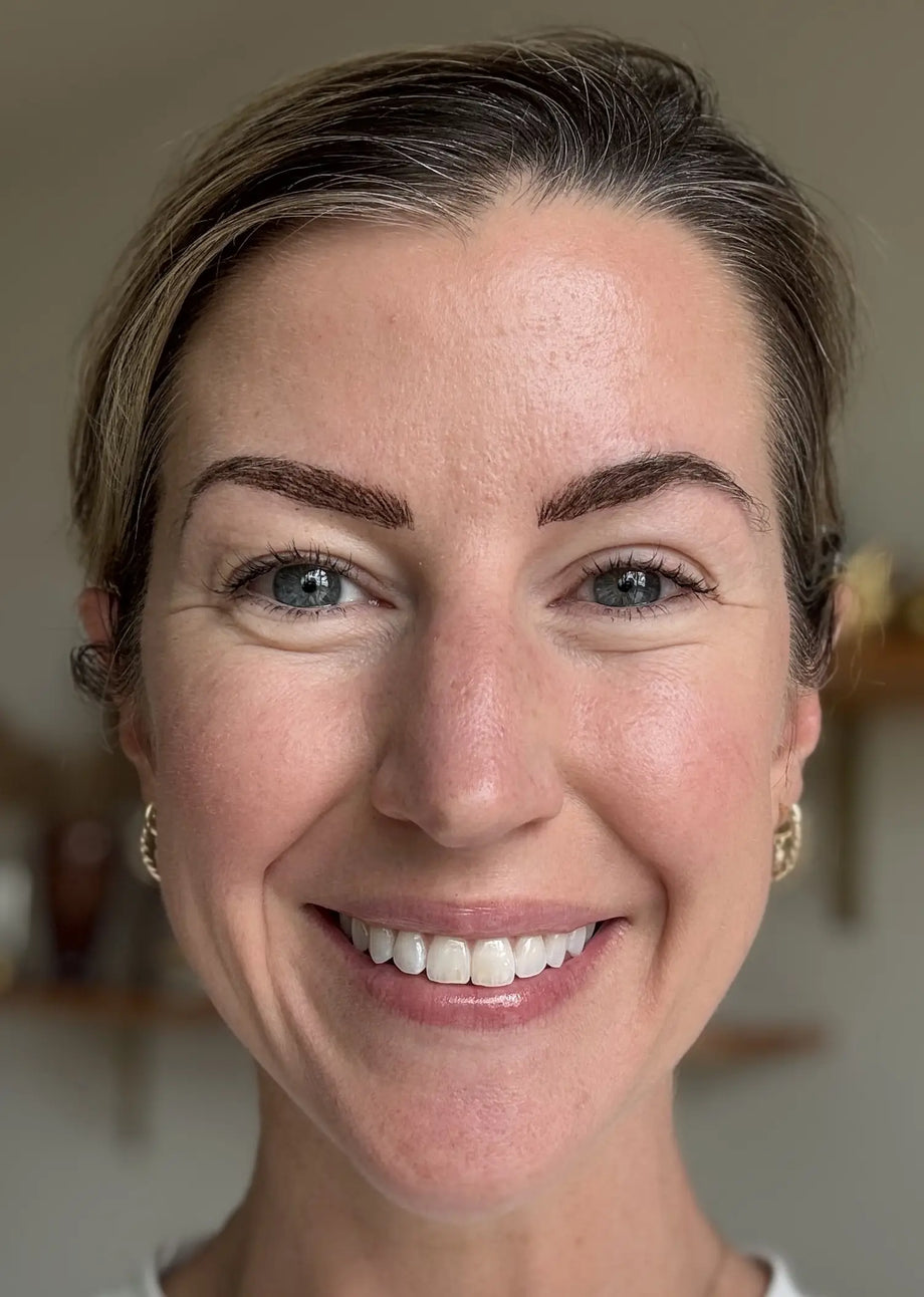Kelly result photo before-and-after eye-area result using GLARISE eyelid strips