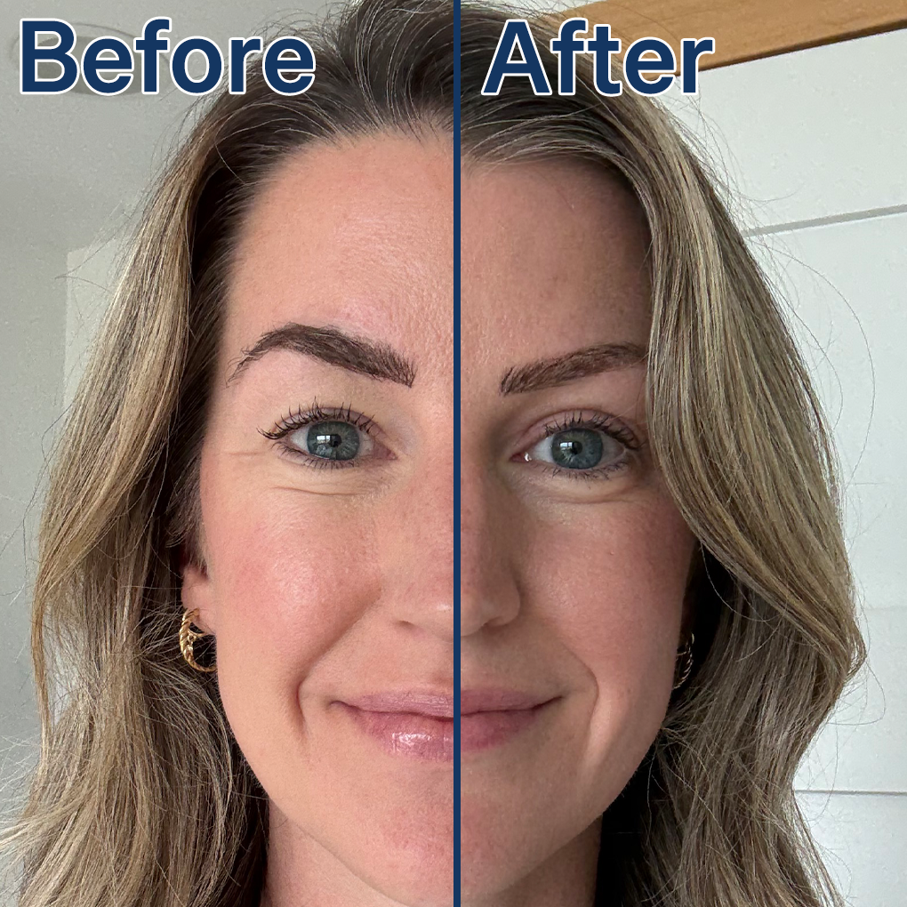 Glarise Corrective Eyelid Strips