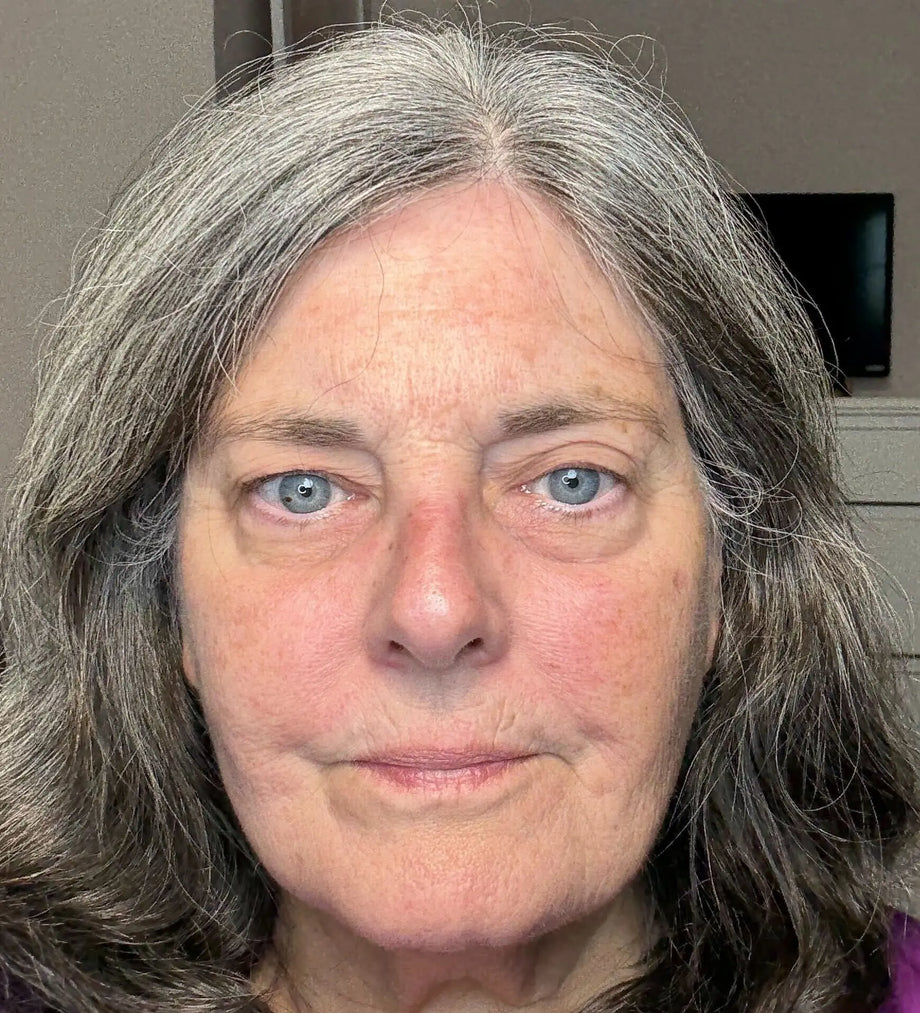Pamela result photo before-and-after eye-area result using GLARISE eyelid strips