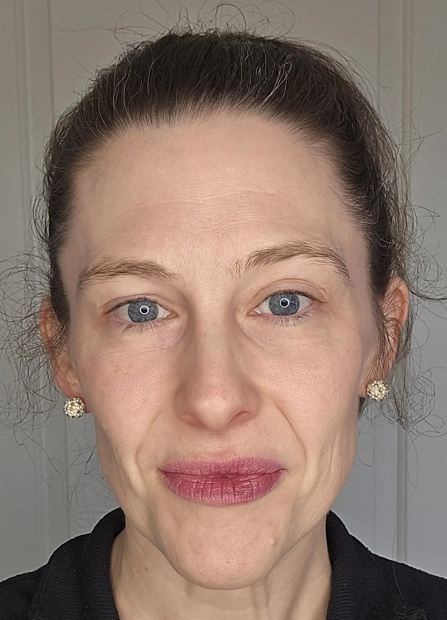 Sarah result photo before-and-after eye-area result using GLARISE eyelid strips